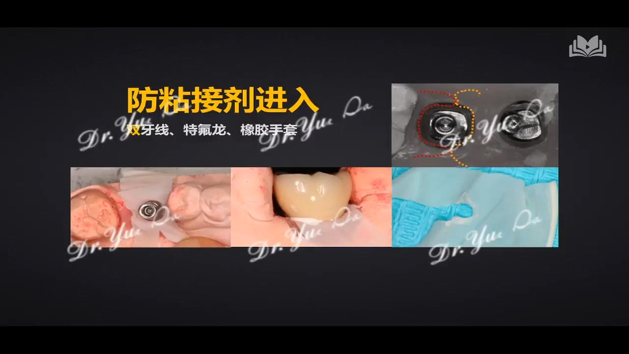 精准派_种植戴牙的流程和细节把控_20220113220259