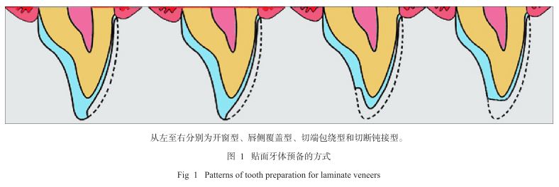 贴面牙体预备分类.JPG